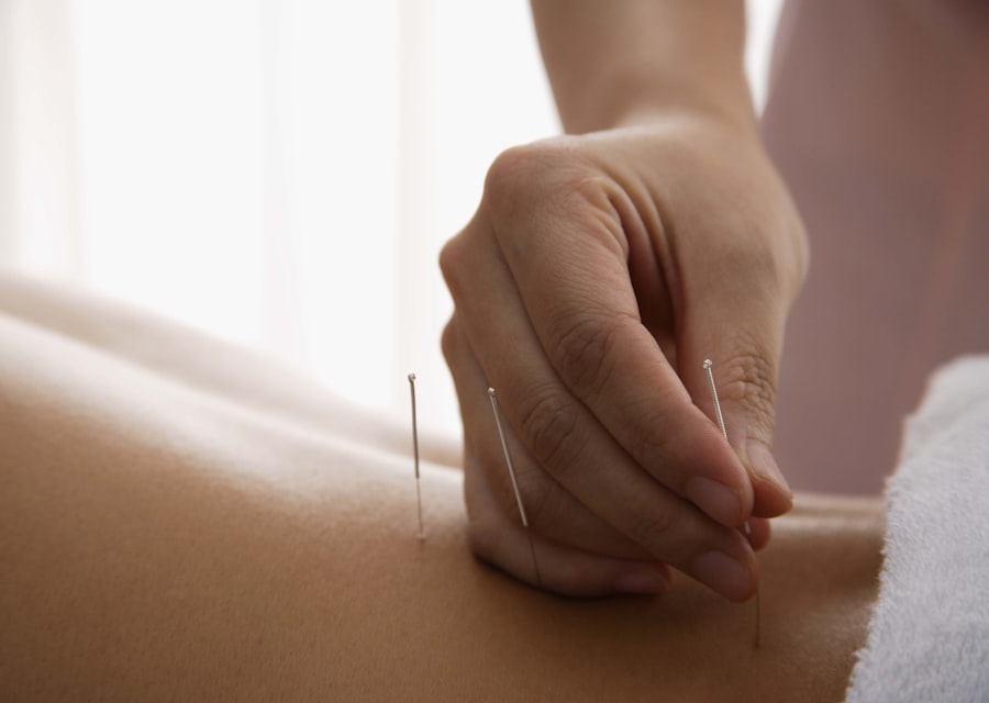 Practitioner gently placing acupuncture needles