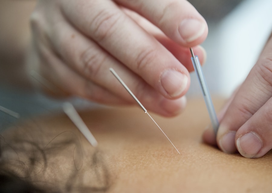 Close-up of acupuncture needles being placed with a guide tube