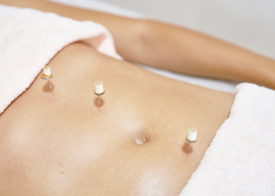 Moxa cones resting on a patient's abdomen during moxibustion